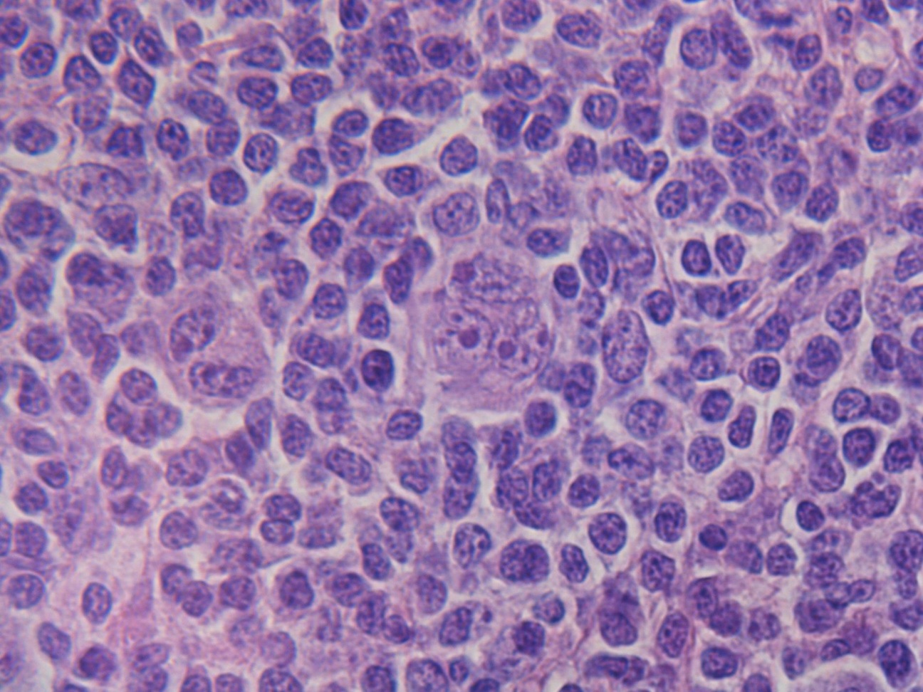 hodgkincellen